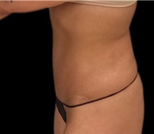 Tummy Tuck After Photo by Steven Hermiz Jr., MD, FACS; Columbia, SC - Case 51614