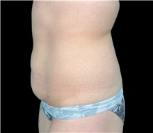 Tummy Tuck Before Photo by Steven Hermiz Jr., MD, FACS; Columbia, SC - Case 51614