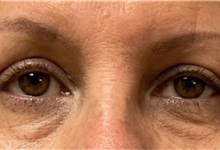 Eyelid Surgery After Photo by Steven Hermiz Jr., MD, FACS; Columbia, SC - Case 51617