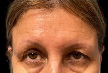 Eyelid Surgery Before Photo by Steven Hermiz Jr., MD, FACS; Columbia, SC - Case 51617