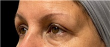 Eyelid Surgery After Photo by Steven Hermiz Jr., MD, FACS; Columbia, SC - Case 51617