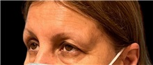 Eyelid Surgery Before Photo by Steven Hermiz Jr., MD, FACS; Columbia, SC - Case 51617