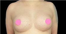 Breast Augmentation After Photo by Steven Hermiz Jr., MD, FACS; Columbia, SC - Case 51615