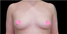 Breast Augmentation Before Photo by Steven Hermiz Jr., MD, FACS; Columbia, SC - Case 51615