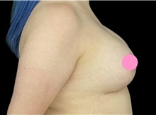 Breast Augmentation After Photo by Steven Hermiz Jr., MD, FACS; Columbia, SC - Case 51615