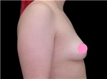 Breast Augmentation Before Photo by Steven Hermiz Jr., MD, FACS; Columbia, SC - Case 51615