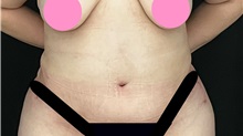 Tummy Tuck After Photo by Steven Hermiz Jr., MD, FACS; Columbia, SC - Case 51616