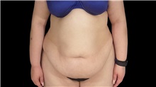 Tummy Tuck Before Photo by Steven Hermiz Jr., MD, FACS; Columbia, SC - Case 51616