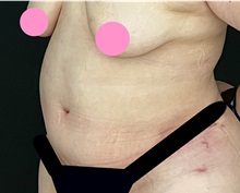 Tummy Tuck After Photo by Steven Hermiz Jr., MD, FACS; Columbia, SC - Case 51616
