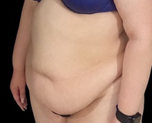 Tummy Tuck Before Photo by Steven Hermiz Jr., MD, FACS; Columbia, SC - Case 51616