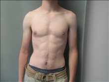 Male Breast Reduction After Photo by Mordcai Blau, MD; White Plains, NY - Case 24807