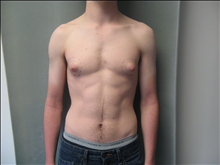Male Breast Reduction Before Photo by Mordcai Blau, MD; White Plains, NY - Case 24807