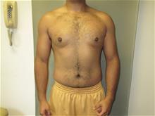 Male Breast Reduction After Photo by Mordcai Blau, MD; White Plains, NY - Case 29310