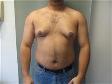 Male Breast Reduction Before Photo by Mordcai Blau, MD; White Plains, NY - Case 29310