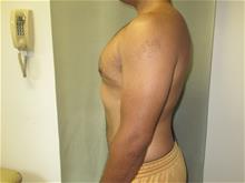 Male Breast Reduction After Photo by Mordcai Blau, MD; White Plains, NY - Case 29310