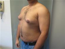 Male Breast Reduction Before Photo by Mordcai Blau, MD; White Plains, NY - Case 29310