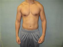 Male Breast Reduction After Photo by Mordcai Blau, MD; White Plains, NY - Case 29315
