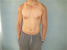 Male Breast Reduction Before Photo by Mordcai Blau, MD; White Plains, NY - Case 29315
