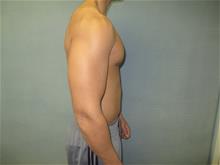 Male Breast Reduction After Photo by Mordcai Blau, MD; White Plains, NY - Case 29315