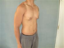 Male Breast Reduction Before Photo by Mordcai Blau, MD; White Plains, NY - Case 29315