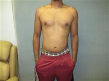 Male Breast Reduction After Photo by Mordcai Blau, MD; White Plains, NY - Case 29316