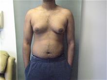 Male Breast Reduction Before Photo by Mordcai Blau, MD; White Plains, NY - Case 29316