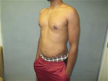 Male Breast Reduction After Photo by Mordcai Blau, MD; White Plains, NY - Case 29316