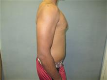 Male Breast Reduction After Photo by Mordcai Blau, MD; White Plains, NY - Case 29316