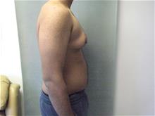 Male Breast Reduction Before Photo by Mordcai Blau, MD; White Plains, NY - Case 29316
