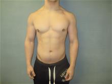 Male Breast Reduction After Photo by Mordcai Blau, MD; White Plains, NY - Case 29317