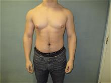 Male Breast Reduction Before Photo by Mordcai Blau, MD; White Plains, NY - Case 29317