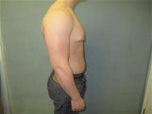 Male Breast Reduction Before Photo by Mordcai Blau, MD; White Plains, NY - Case 29317