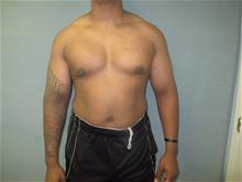 Male Breast Reduction After Photo by Mordcai Blau, MD; White Plains, NY - Case 29318