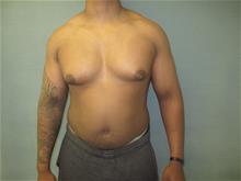 Male Breast Reduction Before Photo by Mordcai Blau, MD; White Plains, NY - Case 29318