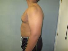 Male Breast Reduction After Photo by Mordcai Blau, MD; White Plains, NY - Case 29318