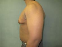 Male Breast Reduction Before Photo by Mordcai Blau, MD; White Plains, NY - Case 29318
