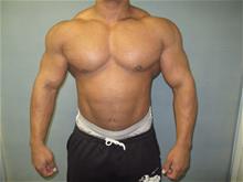 Male Breast Reduction After Photo by Mordcai Blau, MD; White Plains, NY - Case 29319