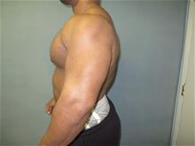 Male Breast Reduction After Photo by Mordcai Blau, MD; White Plains, NY - Case 29319