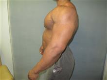 Male Breast Reduction Before Photo by Mordcai Blau, MD; White Plains, NY - Case 29319