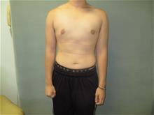 Male Breast Reduction After Photo by Mordcai Blau, MD; White Plains, NY - Case 29320