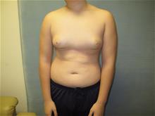 Male Breast Reduction Before Photo by Mordcai Blau, MD; White Plains, NY - Case 29320