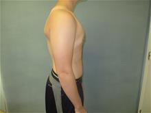 Male Breast Reduction After Photo by Mordcai Blau, MD; White Plains, NY - Case 29320