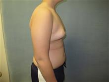 Male Breast Reduction Before Photo by Mordcai Blau, MD; White Plains, NY - Case 29320