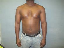 Male Breast Reduction After Photo by Mordcai Blau, MD; White Plains, NY - Case 29321