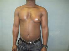 Male Breast Reduction Before Photo by Mordcai Blau, MD; White Plains, NY - Case 29321