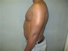 Male Breast Reduction After Photo by Mordcai Blau, MD; White Plains, NY - Case 29321