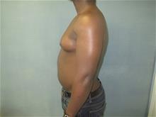Male Breast Reduction Before Photo by Mordcai Blau, MD; White Plains, NY - Case 29321