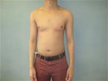 Male Breast Reduction After Photo by Mordcai Blau, MD; White Plains, NY - Case 29322