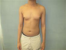 Male Breast Reduction Before Photo by Mordcai Blau, MD; White Plains, NY - Case 29322