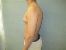 Male Breast Reduction Before Photo by Mordcai Blau, MD; White Plains, NY - Case 29322